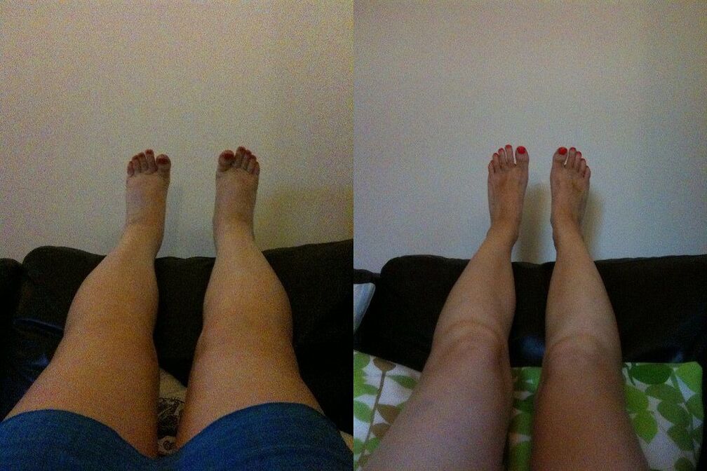 Effective result before and after applying Margarita's Ostelife Premium Plus cream