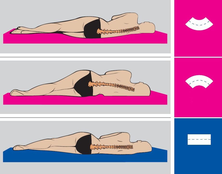 Correct position of the body during sleep with lumbar osteochondrosis. 