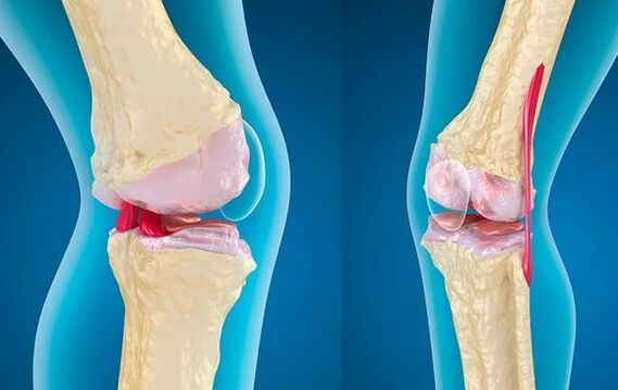 GARONARROSIS OF THE THIRD GRADULATION OF THE KNEE