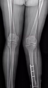 Knee deformations