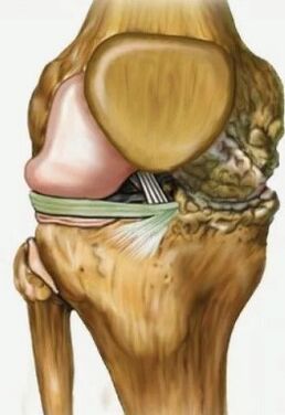 Knee joint osteoarthritis