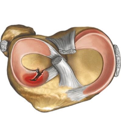 Meniscio lesion