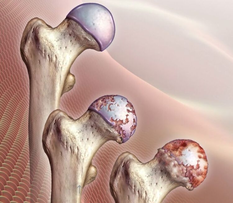 Hip joint osteoarthritis