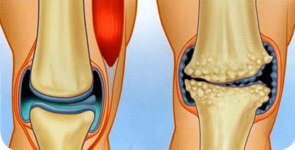 The normal condition of the joint and the causes of the development of the osteoarthritis of the knee
