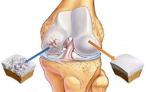standard and deviation for osteoarthritis of the knee joint