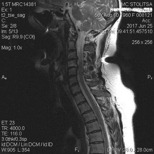 Osteochondrosis and spondyosis of the cervical column