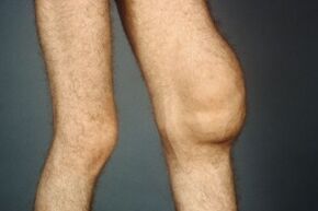 The causes and symptoms of the osteoarthritis of the knee joint