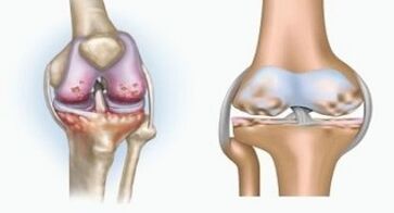 Causes of arthritis and osteoarthritis