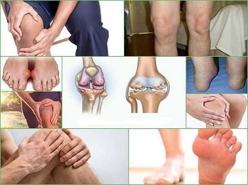 How to prevent the development of arthritis and osteoarthritis