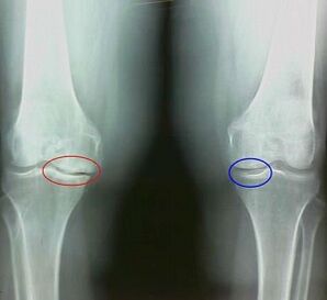 The result of the treatment of arthritis and the popular remedies of osteoarthritis