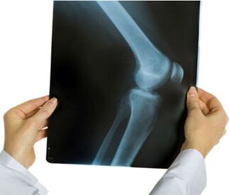 X-ray of osteoarthritis of the knee joint.