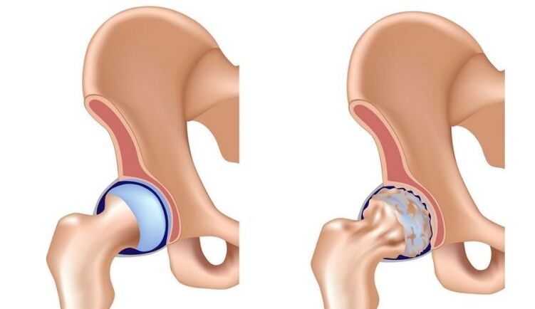 Healthy and articulate with osteoarthritis