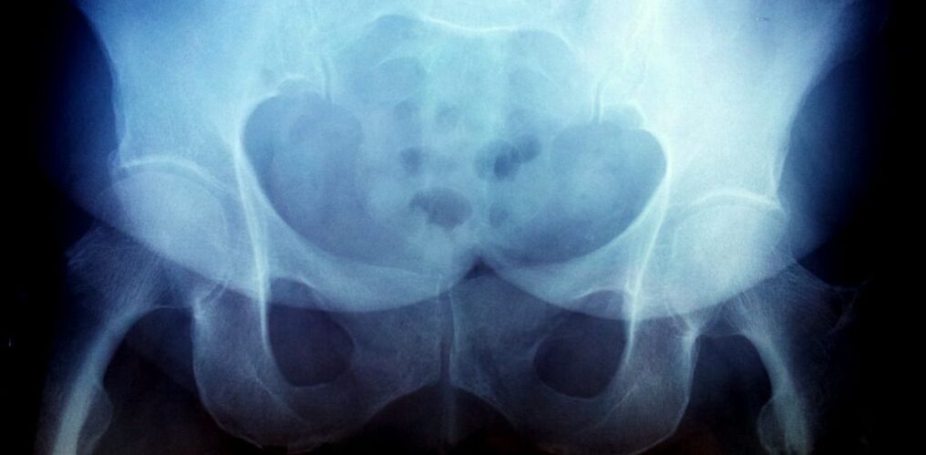 X -ray image with second degree osteoarthritis